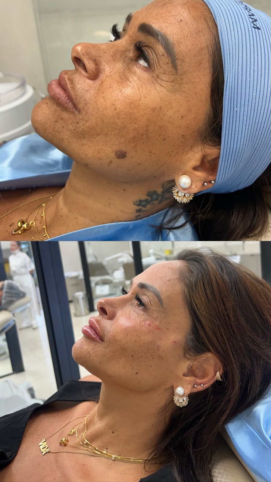 Resultado de harmonização facial feminina — antes e depois